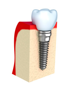 dental implant Glenview